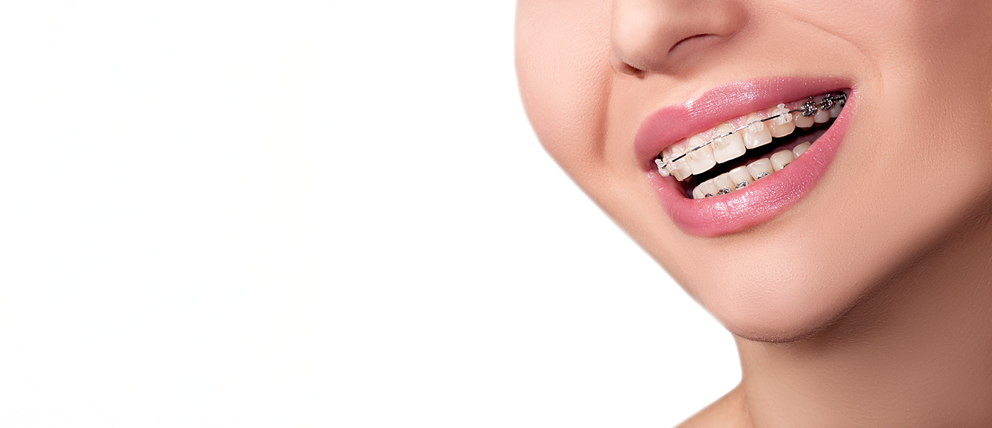 Close up of a person smiling with clear ceramic braces in Round Rock