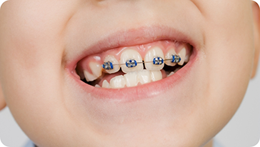 Child with crooked teeth smiling with braces on their upper teeth