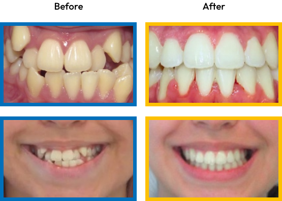 Close up of a smile before and after treating overcrowded teeth