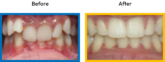 Crowded teeth before and after orthodontic treatment