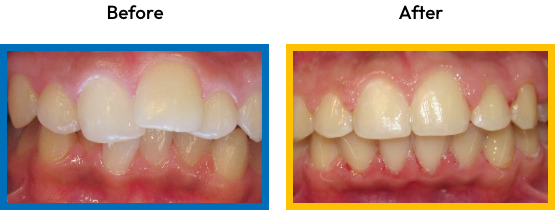 Teeth before and after correcting overcrowding