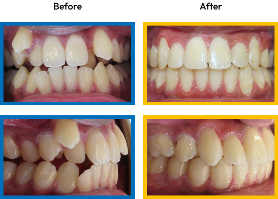 Mouth before and after fixing crowded teeth with orthodontics