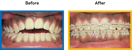 Mouth with an open bite next to the same mouth with braces